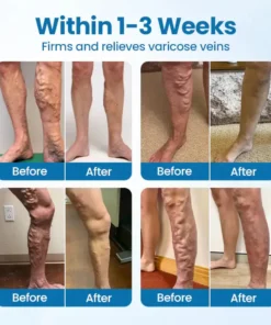 PKNEW® 𝗡𝗼𝗻-𝗜𝗻𝘃𝗮𝘀𝗶𝘃𝗲 Varicose Veins Treatment Laser Pen
