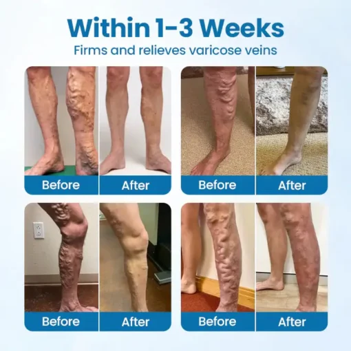 PKNEW® 𝗡𝗼𝗻-𝗜𝗻𝘃𝗮𝘀𝗶𝘃𝗲 Varicose Veins Treatment Laser Pen