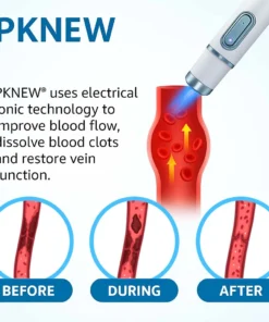 PKNEW® 𝗡𝗼𝗻-𝗜𝗻𝘃𝗮𝘀𝗶𝘃𝗲 Varicose Veins Treatment Laser Pen