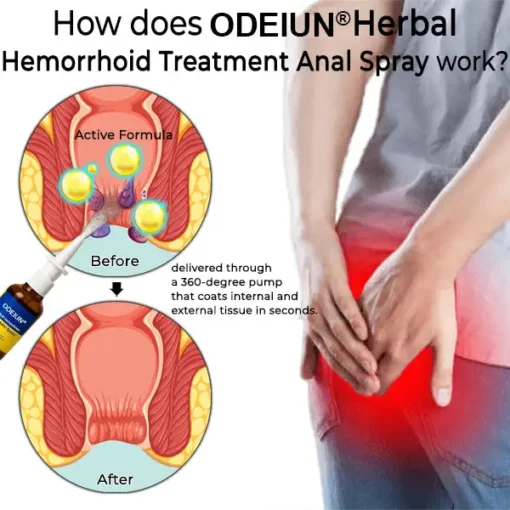 ODEIUN® Hemorrhoid Relief Spray