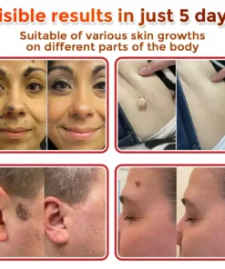 ODEIUN® MicroNeedle Botanic Skin Tag Removal Patch