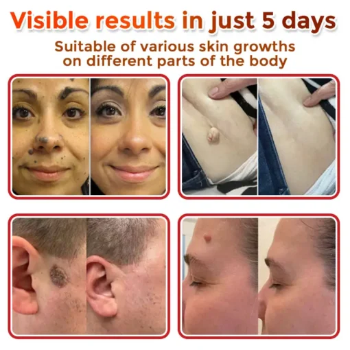 ODEIUN® MicroNeedle Botanic Skin Tag Removal Patch