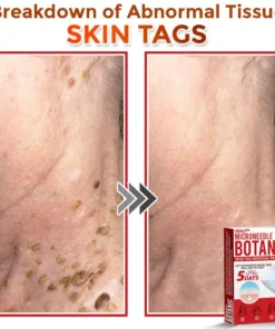 ODEIUN® MicroNeedle Botanic Skin Tag Removal Patch