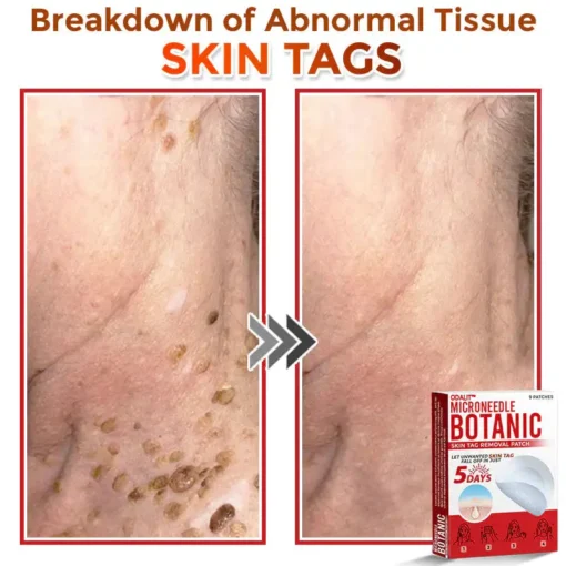 ODEIUN® MicroNeedle Botanic Skin Tag Removal Patch