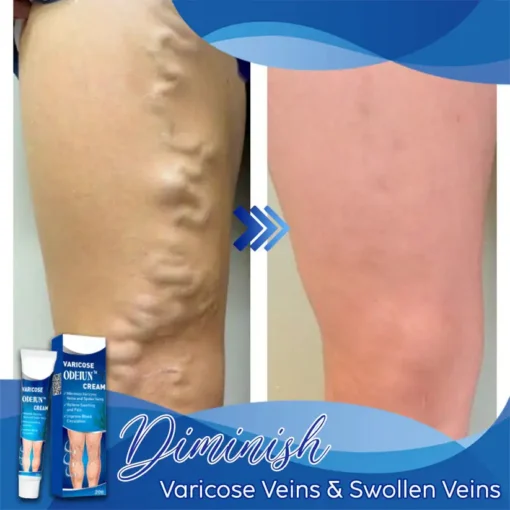 ODEIUN™ Varicose & Spider Vein Cream