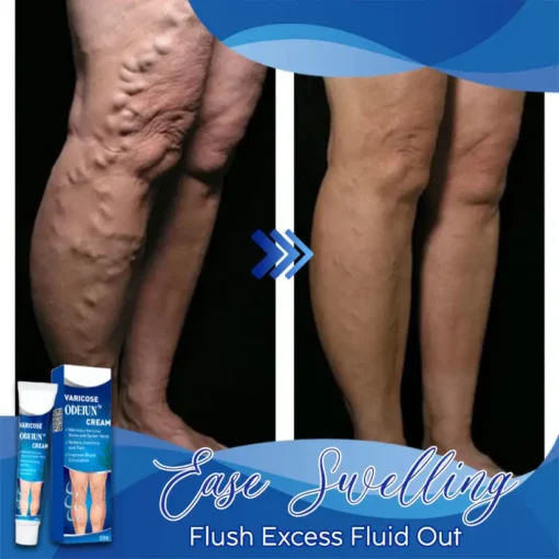 ODEIUN™ Varicose & Spider Vein Cream