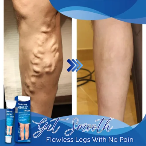 ODEIUN™ Varicose & Spider Vein Cream