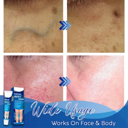 ODEIUN™ Varicose & Spider Vein Cream