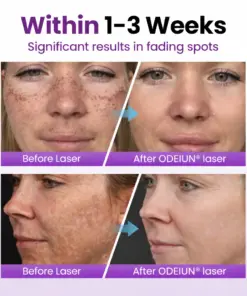 ODEIUN® Spot Erasure Probiotic Shield Serum