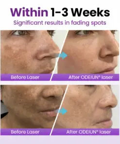 ODEIUN® Spot Erasure Probiotic Shield Serum